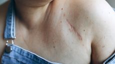 Close-up of a scar on the upper-right-hand-side of a person's chest. They appear to be wearing blue denim dungarees and one of the shoulder straps is falling down their arm to showcase the scar. The scar is red and darker than the skin around it and is a long, thin line.